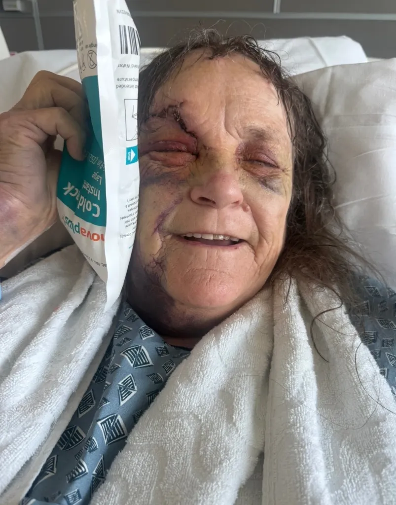 Theresa Garcia, 71, in a hospital bed with severe facial bruising and injuries following an attack.